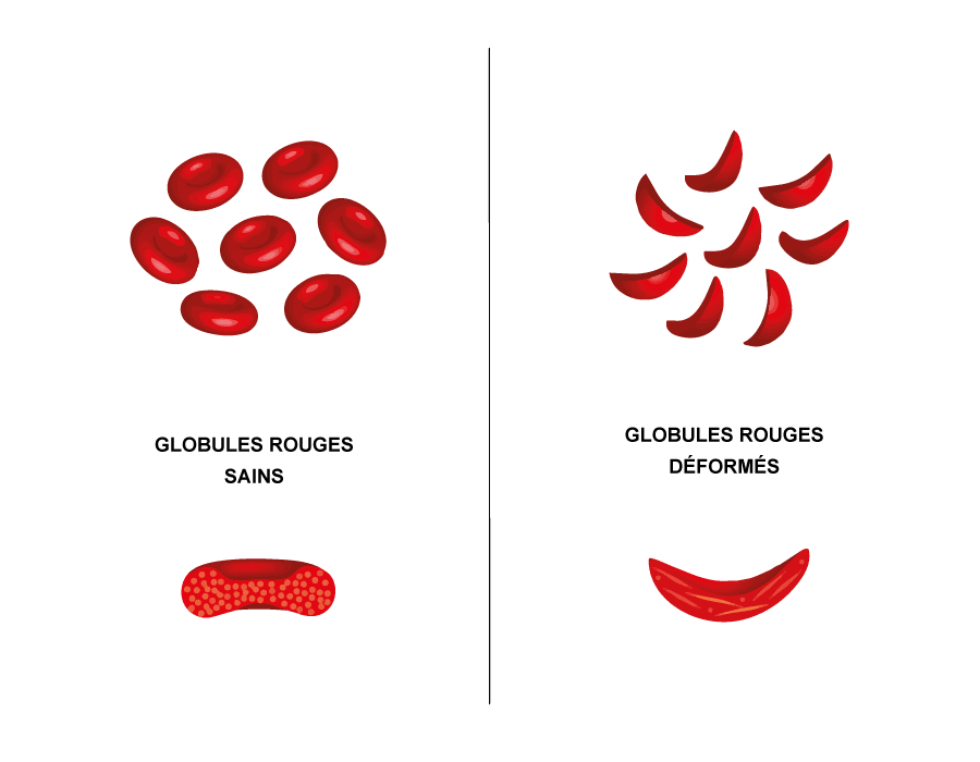 drepanocytose-explication-globules-rouges