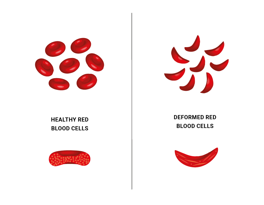 sickle cell disease explanation schema red association donate sickle cell disease explanation schema red association donate